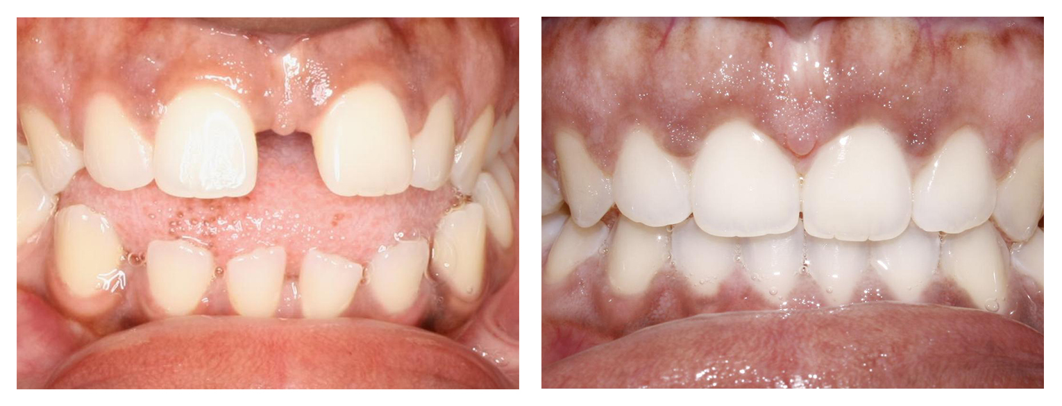 Invisalign Before and After